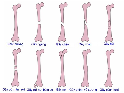 Chữa nứt xương bằng xương nhân tạo